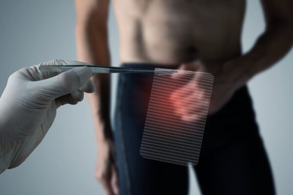 Βουβωνοκήλη στον Άντρα – Όσα πρέπει να γνωρίζουμε!