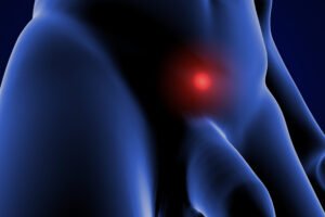 Βουβωνοκήλη στους Όρχεις - Θεραπεία & Αντιμετώπιση